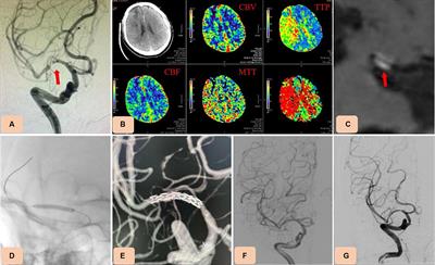 Endovascular treatment of symptomatic severe intracranial atherosclerotic stenosis with a novel intracranial dedicated drug-eluting stent: a more effective treatment approach